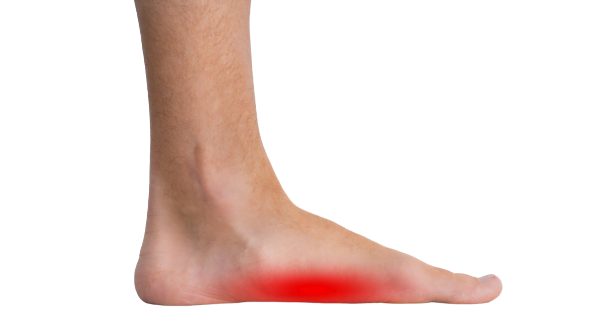 Durchgesunkener Fuß | Plattfuß vorbeugen