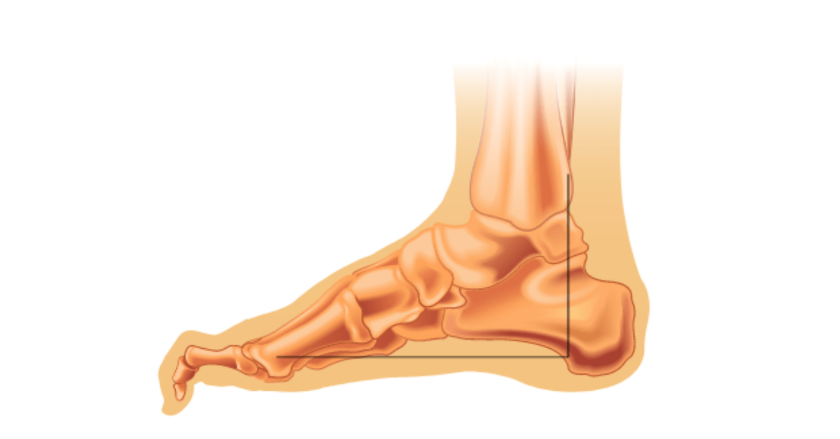 Hammerzehen: Schmerzhaft, aber behandelbar