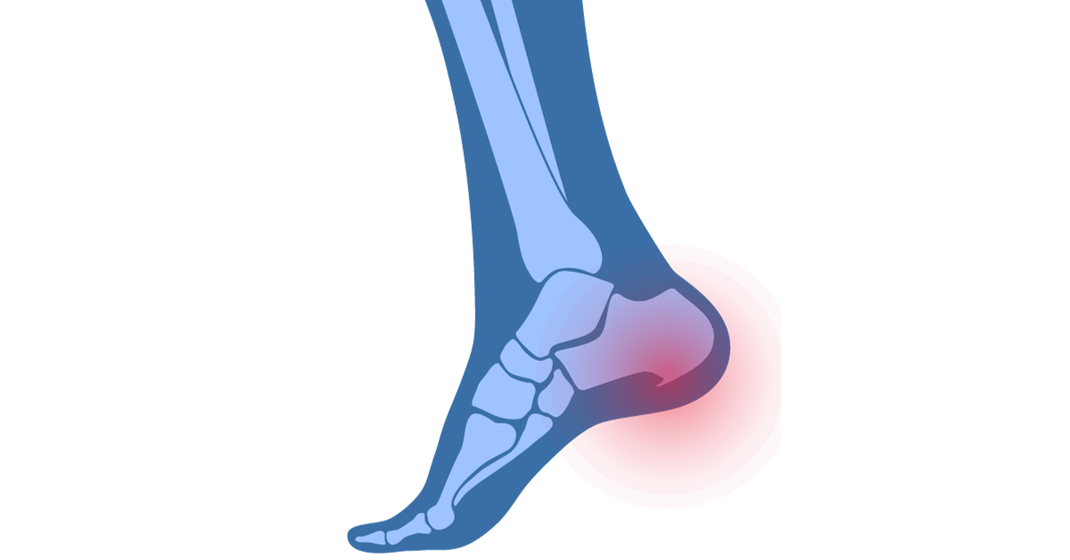Fersensporn - Schmerzen an der Ferse lindern