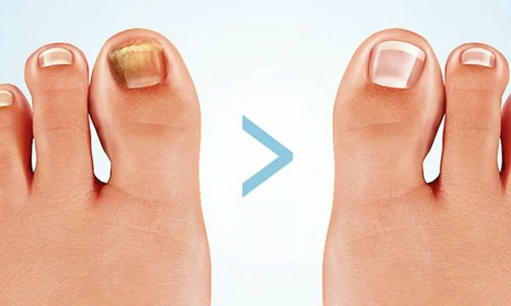 Behandlung von Nagelpilz