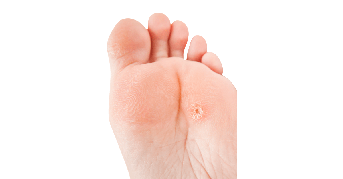 Hühnerauge entfernen, behandeln und vorbeugen